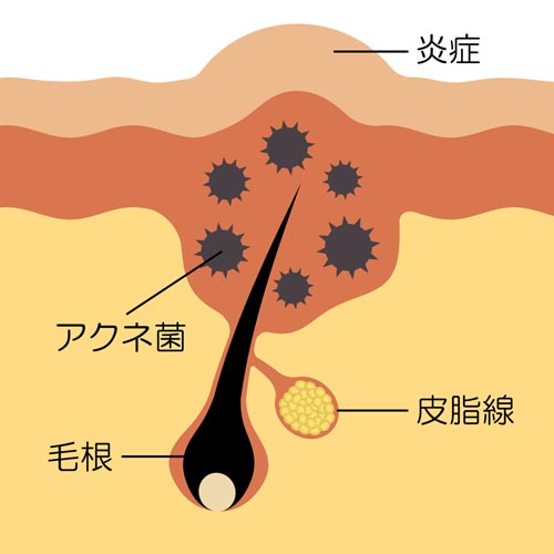 毛穴とニキビのイラスト