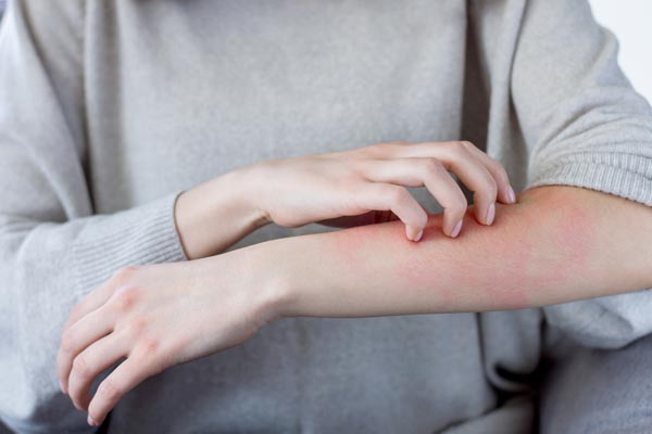 アレルギーで赤くなった腕を掻く女性