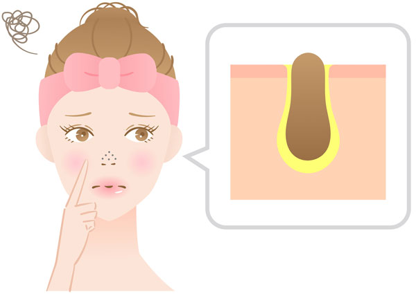 鼻の角栓のイラスト