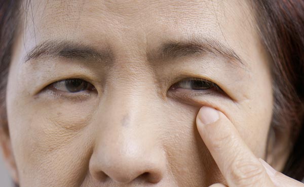 中年女性の目の下のたるみとシワ