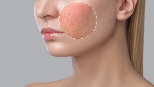 顔が肌荒れした女性