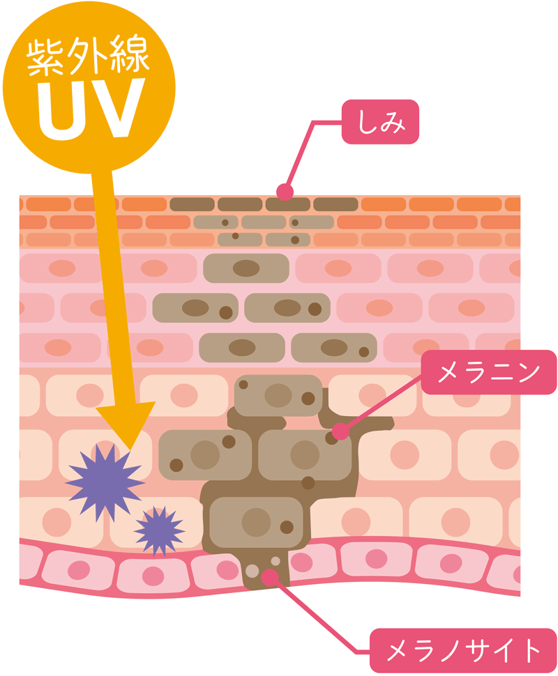 紫外線をうけた肌の断面図