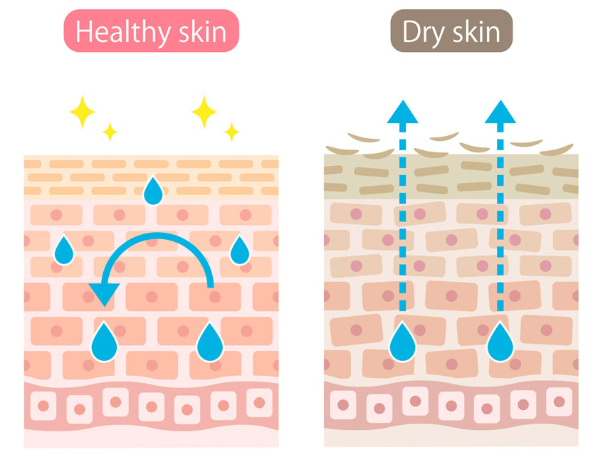 健康な肌とドライスキンの断面図