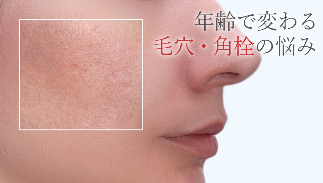 年齢で変わる毛穴・角栓の悩み