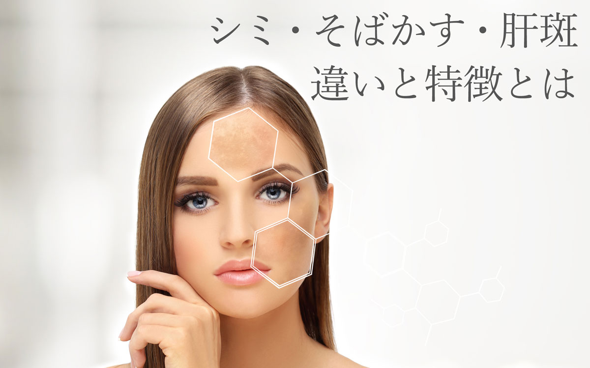 シミ・そばかす・肝斑、それぞれの違いと特徴とは