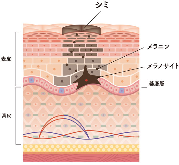 シミのある肌の断面図イラスト
