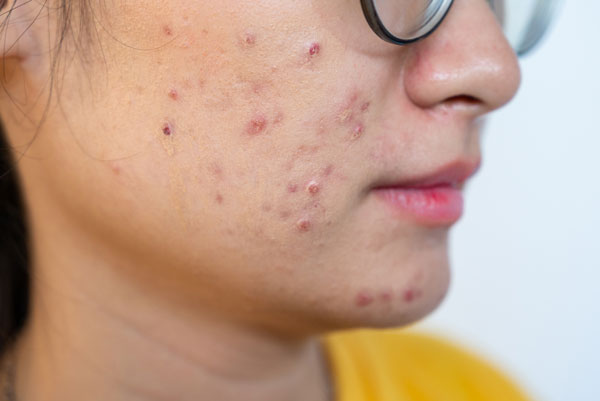 ニキビ跡のある女性の肌