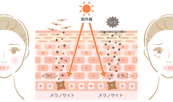 紫外線と肌のシミのイラスト