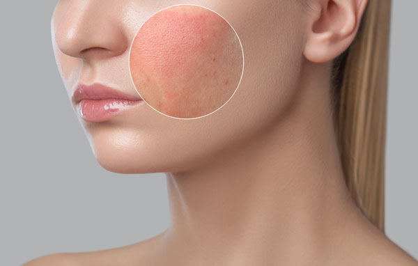 頬が赤く肌荒れしている女性