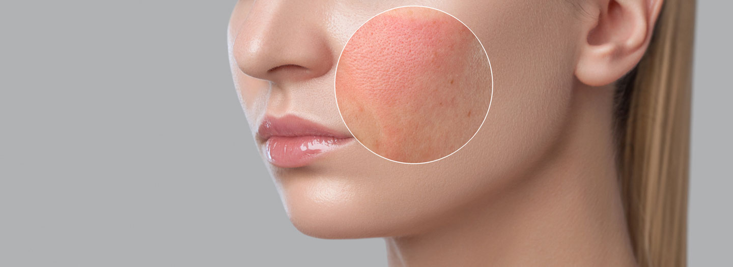 頬に赤みのトラブルがある女性