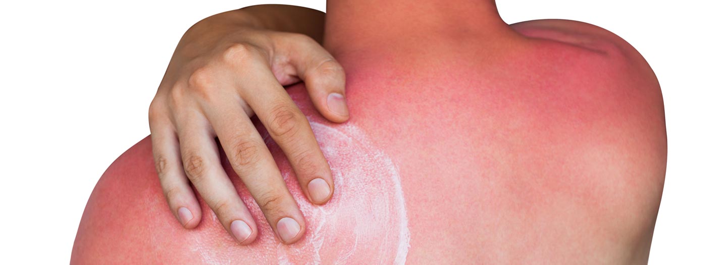 日焼けした背中にクリームを塗る