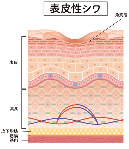 乾燥性の表皮性ジワのイラスト