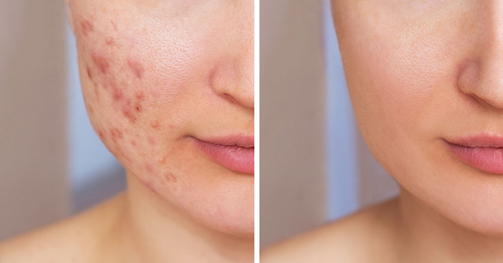 顔の皮膚が肌荒れした状態と治った状態