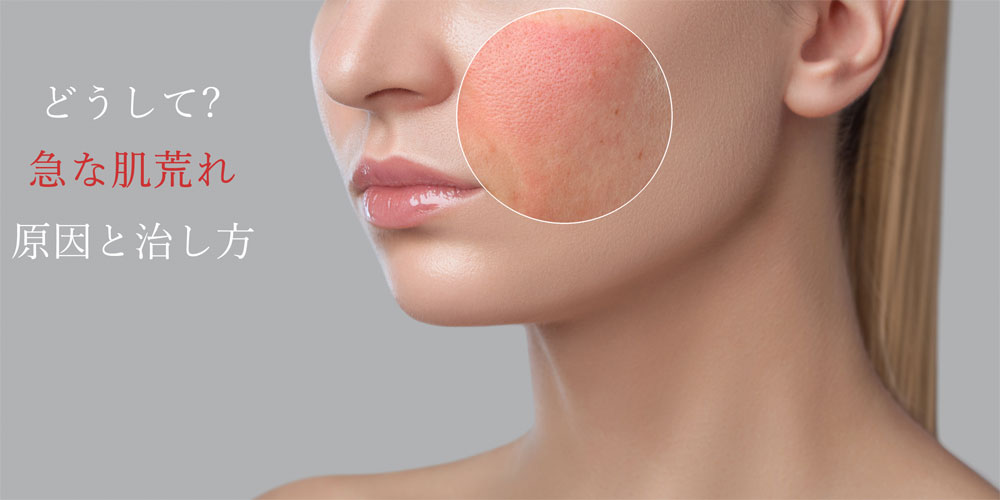 急な肌荒れの原因と治し方