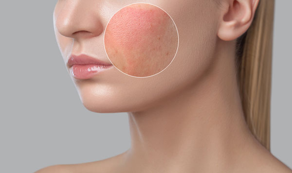 頬が赤く肌荒れしている女性