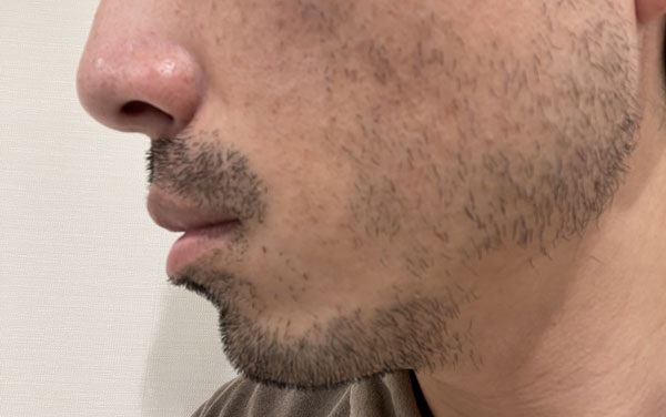 男性の無精ひげ