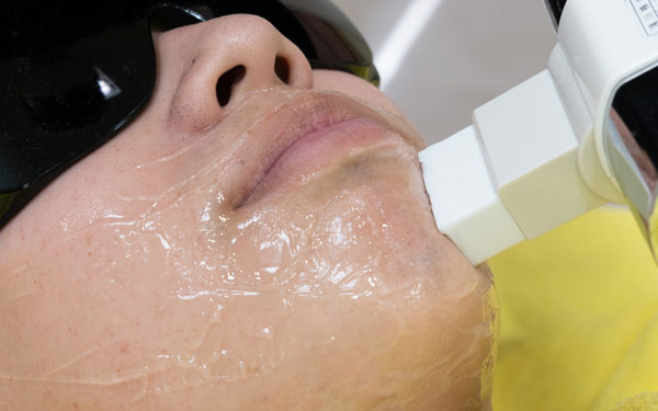 エステでひげ脱毛を受ける男性