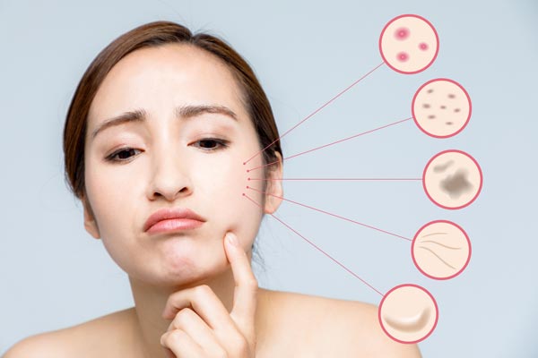 肌トラブルに悩む女性