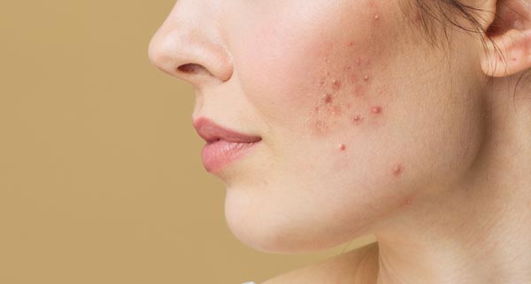 頬にニキビのできた女性の顔